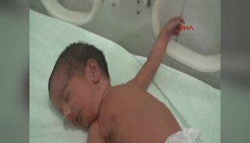 Aynı karaciğeri paylaşan siyam ikizleri dünyaya geldi