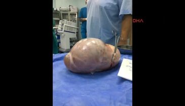 Karnından 5 kilo 650 gram kist çıktı