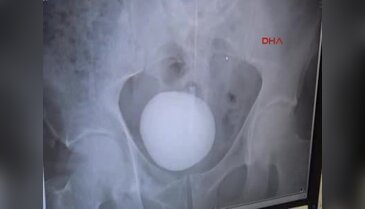 12 santimlik taş operasyonla alındı
