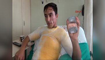 Üniversite öğrencisini kaynar suyla haşladılar